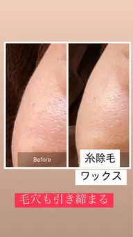 フェイスWax（2ヶ月以内）