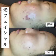 頑固な肌悩みに🍀光フェイシャル×コラーゲンパック🌈