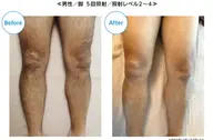 【足全体脱毛】冬の間に脚ツルツル✨メンズ専用