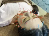 ハリネズミ美容鍼『美顔ケア美鍼』肌質ケア美容鍼(美容針)+10種から選べる美容パック付き