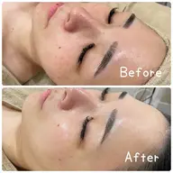 光フェイシャル美容脱毛