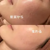 【お肌の変化No.1🌼】便秘解消/生理痛緩和🤍ピーリング&温熱イオンパック&お腹マッサージのお得メニュー✨