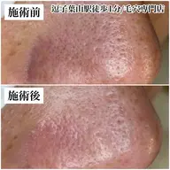 毛穴美コース　お着替えなし70分　通常12,000円→初回10,000円