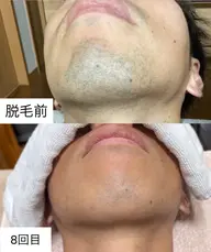 メンズ総合コース(カット＋シャンプー＋眉毛カット＋顔剃り)＋ヒゲ脱毛(部分痛み少ない美肌脱毛キャンペーン価額)