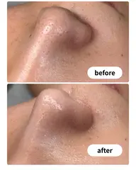 毛穴洗浄✨️ハイドロピールで毛穴とニキビの根源を洗浄🫧