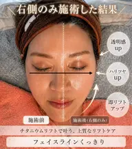 【即リフトアップ】最新マシン♪チタニウムリフト。透明感×ハリ×リフトアップ※期間限定価格