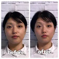 【眼精疲労・頭痛スッキリ】美容鍼×ヘッドスパ ¥14,000→¥5,980