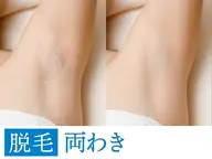 【ミニモ限定✨】両ワキ脱毛600円(通常6600円)気になる自己処理をラクに🫧 新人価格でのご案内💁♀️6月末まで