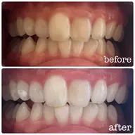 ✨ホワイトニング✨ナチュラルホワイトニング8分×5照射🦷🪥