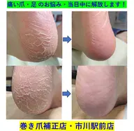 トータルフットケア(足裏全体角質ケア) (google口コミ投稿特別価格)