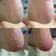 【カカトケア】朗報✨【🉐2回目以降もずっと"施術料が500円🉐】ガサガサ角質もツルスベに✨✨仕上がり大満足💁‍♀️