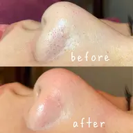 minimo限定　毛穴集中ケアコース『毛穴の詰まり、黒ずみ、開きのお悩み一網打尽✨』