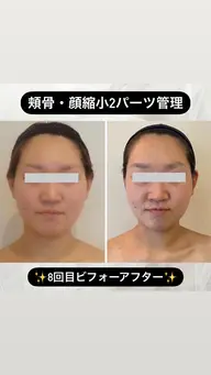 お顔をしっかりと定着させたい方1パーツ10回コース通常¥165,000円→‼️¥50,000‼️破格です👀‼️