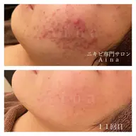 【ニキビ・ニキビ跡】徹底ケアコース　デコルテトリートメント付き