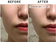 【3超音波3D小顔リフトアップ/全顔】輪郭スッキリ！その場で実感✨毛穴洗浄付き💕