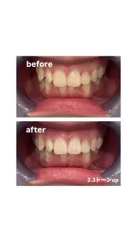 歯のホワイトニング10分×2回　3回回数券