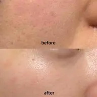 まつ毛パーマ+乳酸ピーリング💖