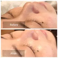 【つや・小顔・美白】初回オススメ🔰つや肌重視コース！塗るヒアルロン酸でつやっ✨触りたくなるお肌に❣️