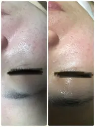 お肌のﾌﾟﾙﾌﾟﾙ❤ヒト幹細胞培養液導入コース✨