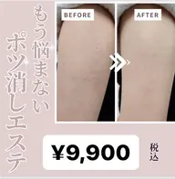 夏が来る前に今こそ二の腕ポツ消しエステ
