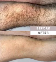 ［仙台　メンズ脱毛］メンズ脱毛足