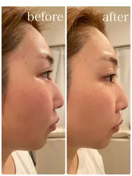 1番人気❗️【小顔矯正+4000ショット全顔アゴ下】たるみ／小顔
