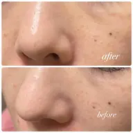 ミニモ限定【お試し】毛穴ディープクレンジング洗浄【浮き出す角栓】メンズ〇