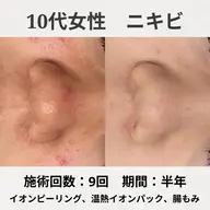学生限定《皮膚科通いの方🏥》薬を止めると出てくるニキビ😭からの解放🌸集中ケアパックで根本改善で徹底アプローチ👀