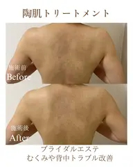 【お試し】ボディREVIハーブピーリング🌿（背中・腕・ヒップ）