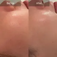 花粉/肌荒れ/ニキビケア！！肌荒れにお悩みの方はこちら💁🏼‍♀️