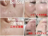 【都度払い】韓国風肌管理◎赤ニキビにお悩みの方へ[カウンセリングからお客様に合ったメニューを相談]