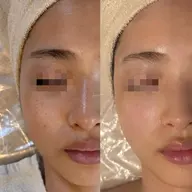 【毛穴・くすみ】水素プラチナフェイシャル