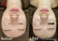 【10~16時限定】REVIハーブピーリング通常新規¥11,660→¥9,460