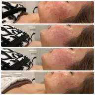 【敏感肌でも大丈夫な肌質改善】ニキビ･ニキビ跡集中‼️ダウンタイムなし！天然ハーブピーリング🌿20.30代の肌作り🩵