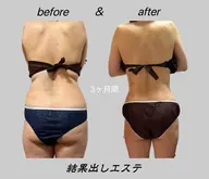 【後ろ姿まで美しく】背面集中痩身ボディデザイン60分21,000円→