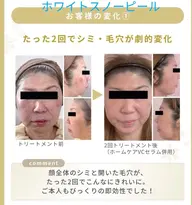 エリア初導入【透明感・ツヤ特化】ホワイトスノーピール・水光コース
