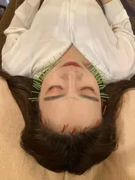 【ミニモ限定】小顔美容鍼60本コース