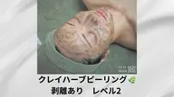 【しっかり変化】剥離ありハーブ2倍で肌質改善