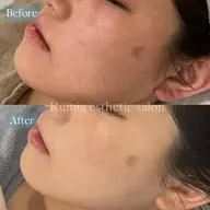 お肌悩みに合わせたクリスティーナピーリング➕毛穴洗浄＆高濃度美容液¥22,000→¥9,900🩵