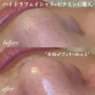 人気No.1🏆【しつこいニキビ・黒ずみ卒業✨】集中毛穴ケアコース👌🏻ハイドラ+ビタミンC導入🍋口コミ価格💭
