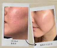 ☆◇【VOSサロンケア】全世代のお悩みに　話題のVOSフェイシャル♪ブラックとホワイトご用意してます
