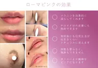 韓国最新高級美容ローマピンク👄ミニモセール限定価格