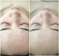 【巡りが整い、代謝が上がる】REVIハーブピーリング