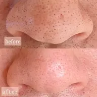 WAXでスッキリ小鼻の毛穴ケア❤️✨黒ずみザラつきスッキリ✨やみつき✨