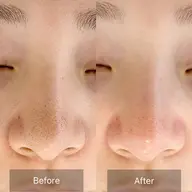 毛穴エクストラクション90分フルコース✨