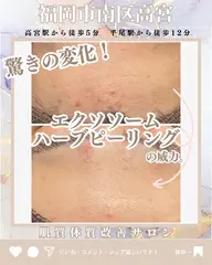 悩むあなたにスペシャルケア【毛穴洗浄+再生修復ハープピーリング】23000円→10,000円