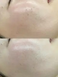 プレミアムプラズマ水素パックトリートメント