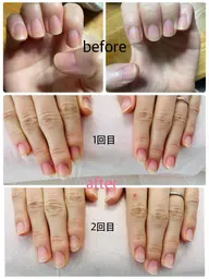 深爪矯正​〜​軽度コース初回​〜​ホームケアセット           深爪矯正​〜​重度コース初回​〜​ホームケアセット¥18500