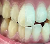 2ヶ月間通い放題コース