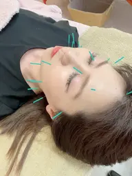 💎ワンランク上の美容鍼💎小顔矯正+電気美容鍼でたるみ改善&ハリツヤUP ✨